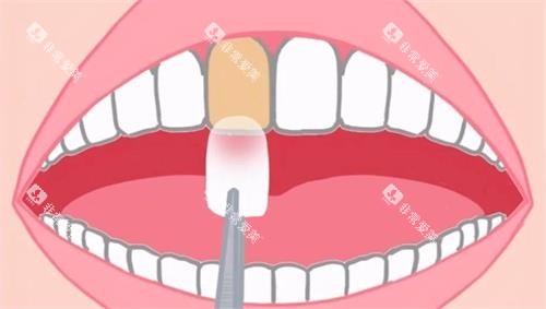 牙齿贴面动画示意图 牙齿贴面动画示意图