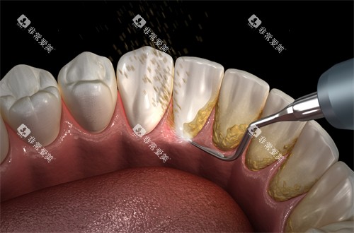 洗牙清洁牙齿结石 洗牙清洁牙齿结石