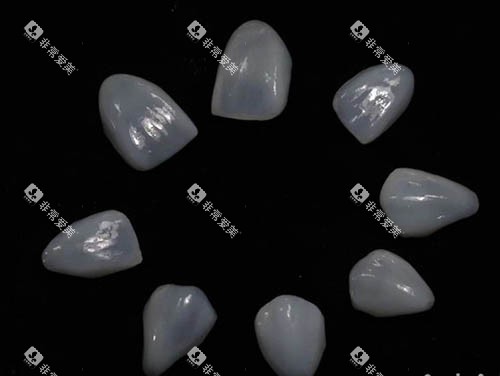 牙齿贴面照片 牙齿贴面照片