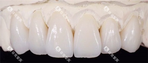 vita全瓷牙展示