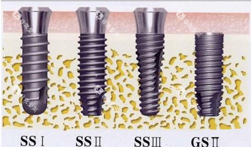 奥齿泰植体示意图