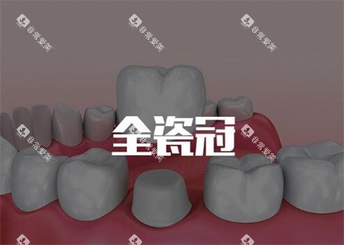 全瓷牙冠修复改善