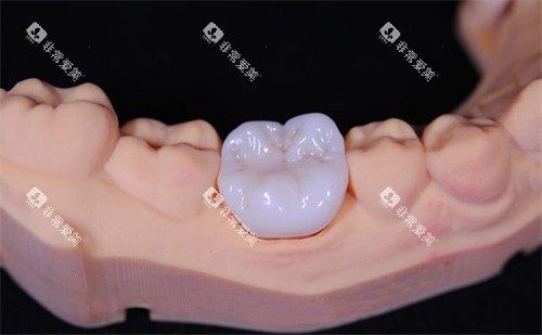 全瓷牙冠