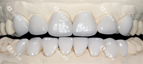 全瓷牙的光泽和颜色