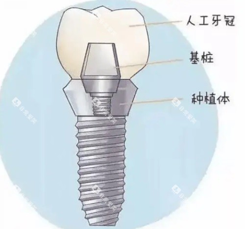 种植牙组成示意图