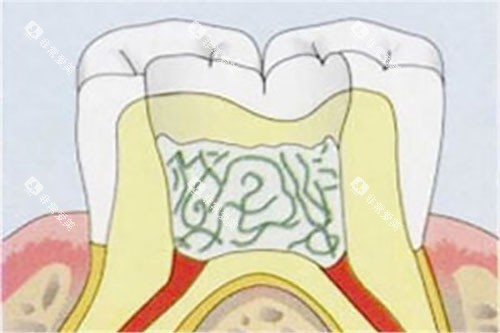 活髓切断示意图