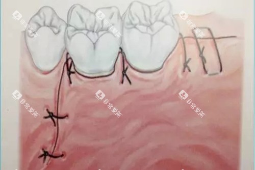 牙龈翻瓣切口卡通示意图