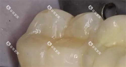 3M树脂补牙