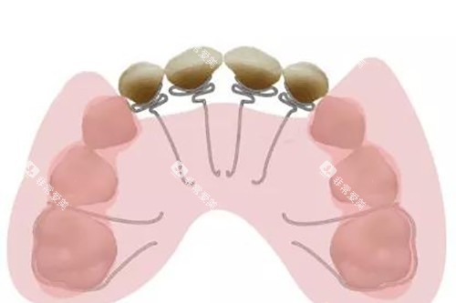 推簧卡通示意图