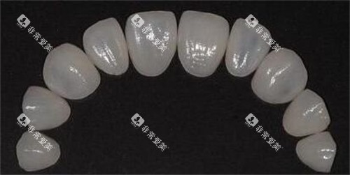 牙贴面修复改善