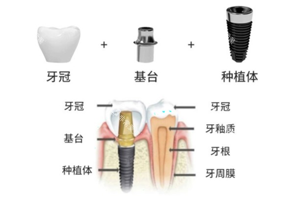 威高种植牙手术过程示意图