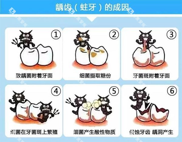 蛀牙的种类