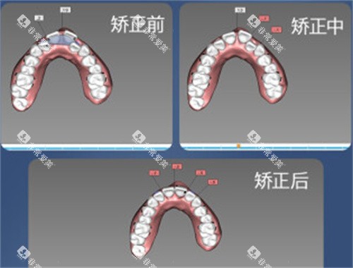 牙齿矫正设计图
