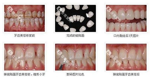 不同方式牙齿美白示意图