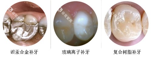 补牙材料示意图