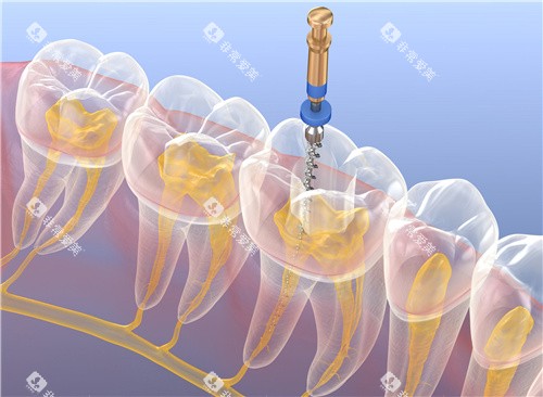 根管治疗透视图