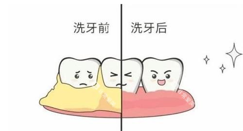 洗牙前后的对比