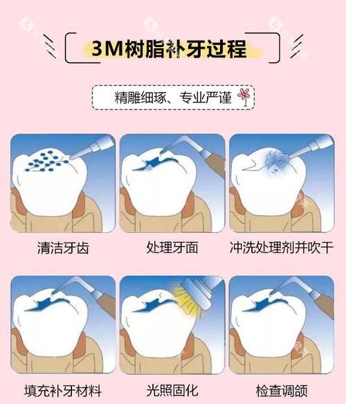 3M树脂补牙方法