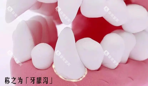 牙龈沟位置图示.webp