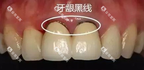 牙龈黑线示意图