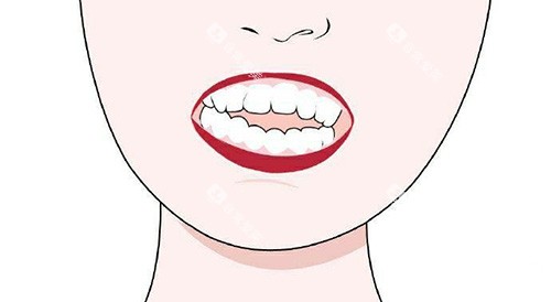 口腔开颌漫画示意图