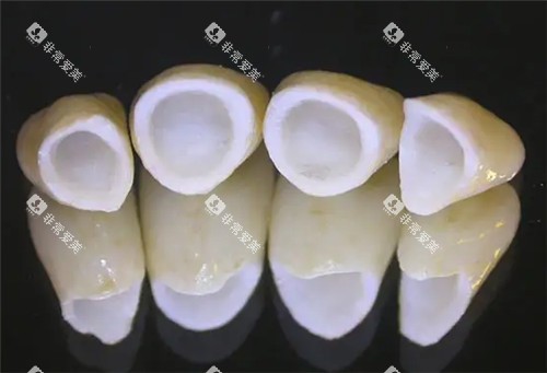 全瓷牙连桥冠照片