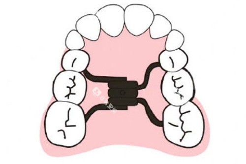 正畸扩弓卡通图