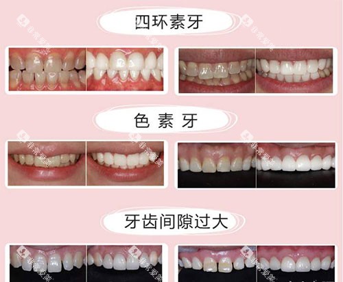 不同牙齿需要美白的示意图