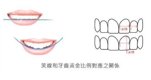 正畸微笑线