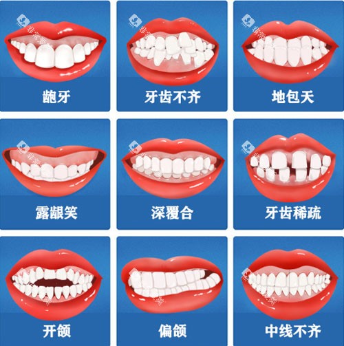 牙齿矫正适应症