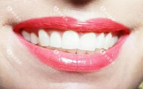 标准门牙图片.webp