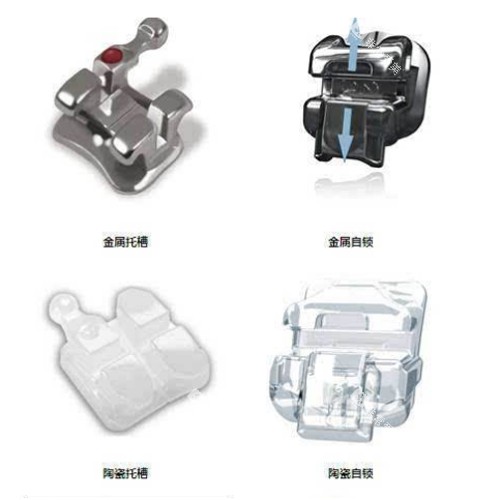 托槽矫正的不同类型