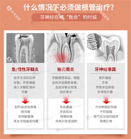 适合做根管治疗的情况