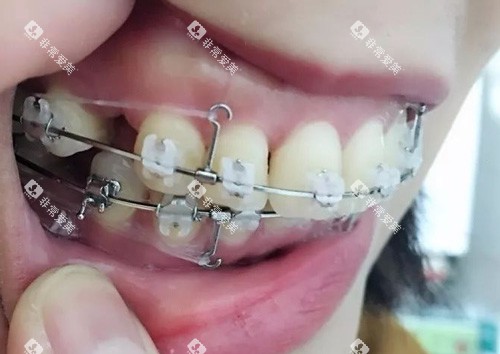 半隐形矫正细节图