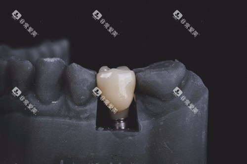 牙齿修复示意图