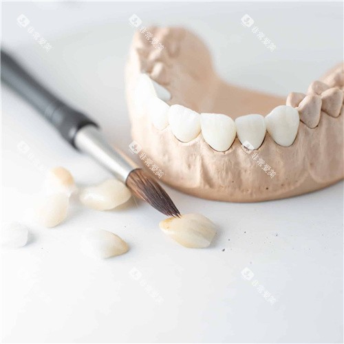牙齿贴面成品图