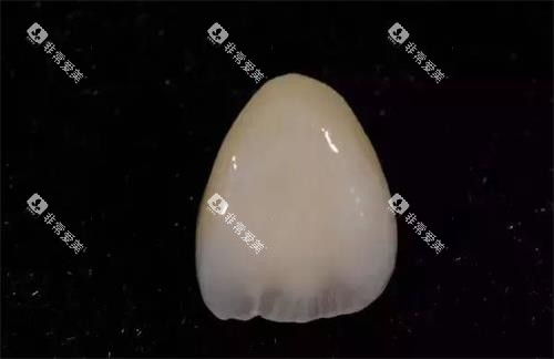 单颗全瓷牙示意图