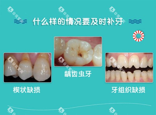 补牙适应症
