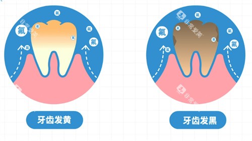 氟斑牙