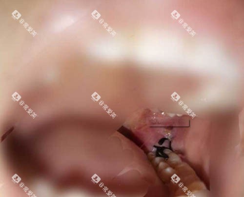 拔牙伤口缝合
