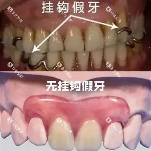 挂钩假牙和无挂钩假牙示意图