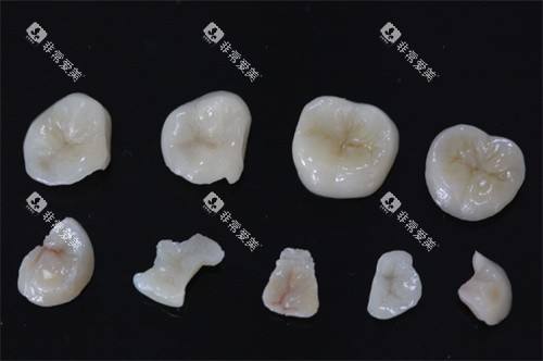 铸瓷嵌体