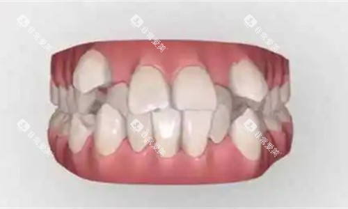 虎牙畸形模具图