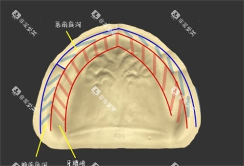 无牙颌细节照片