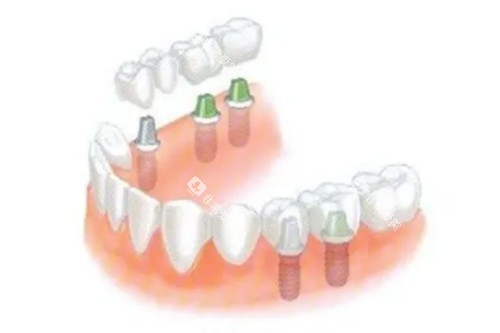 多颗种植牙卡通图片展示