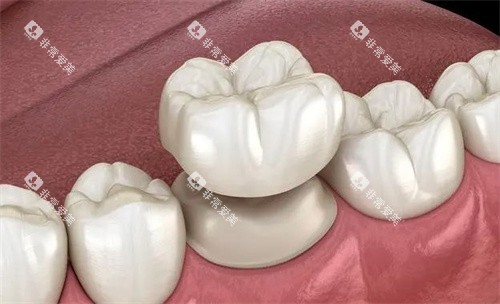 牙冠是怎么做的