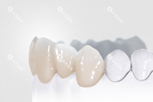 全瓷牙冠模型图