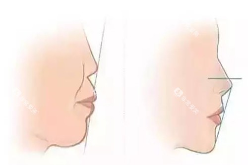 正畸前后侧脸对比示意图