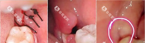 拔智齿缝合示意图
