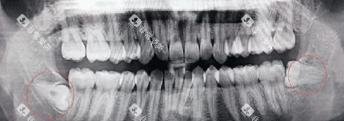 智齿牙片示意图
